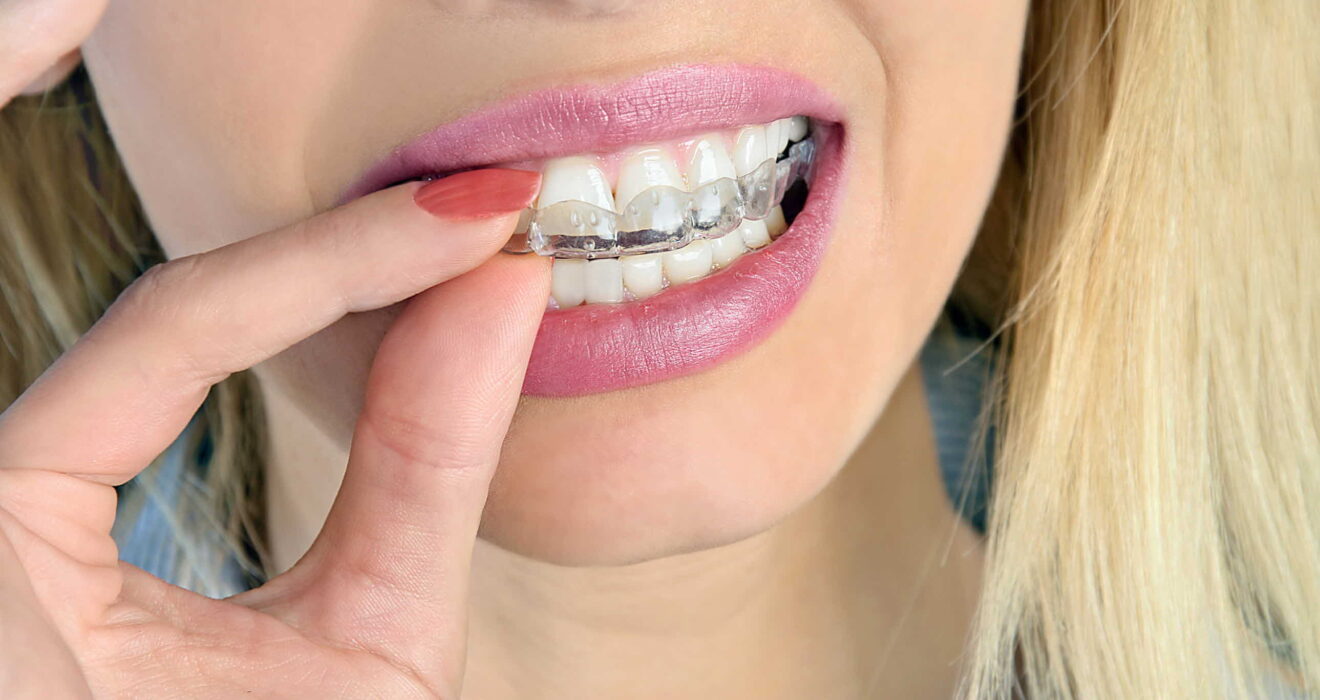 隱適美推薦必看！想做隱適美卻不知怎麼挑醫師？